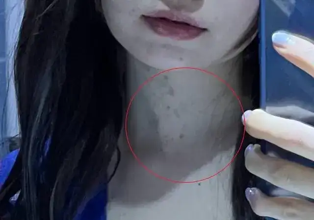 陈卓璇的脖子怎么回事儿,陈卓璇脖子里的一块块斑是什么-2 陈卓璇的脖子怎么回事儿,陈卓璇脖子里的一块块斑是什么